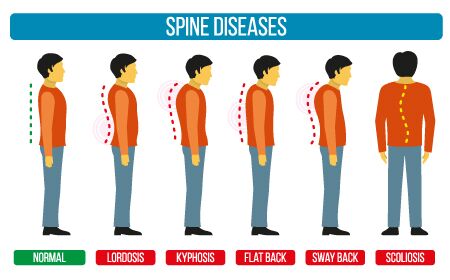 Spine Diseases