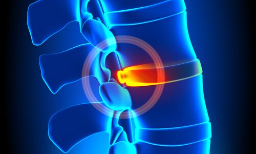 Spinal Decompression Therapy