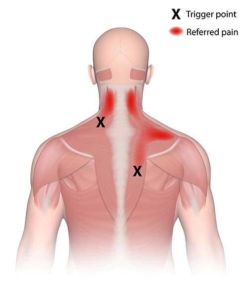 Trigger Point Injections